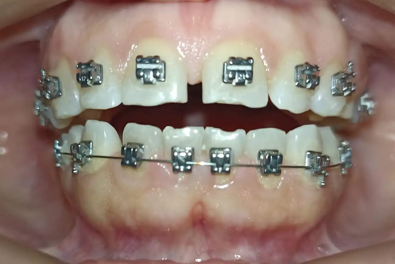 Antes del tratamiento de Vicky